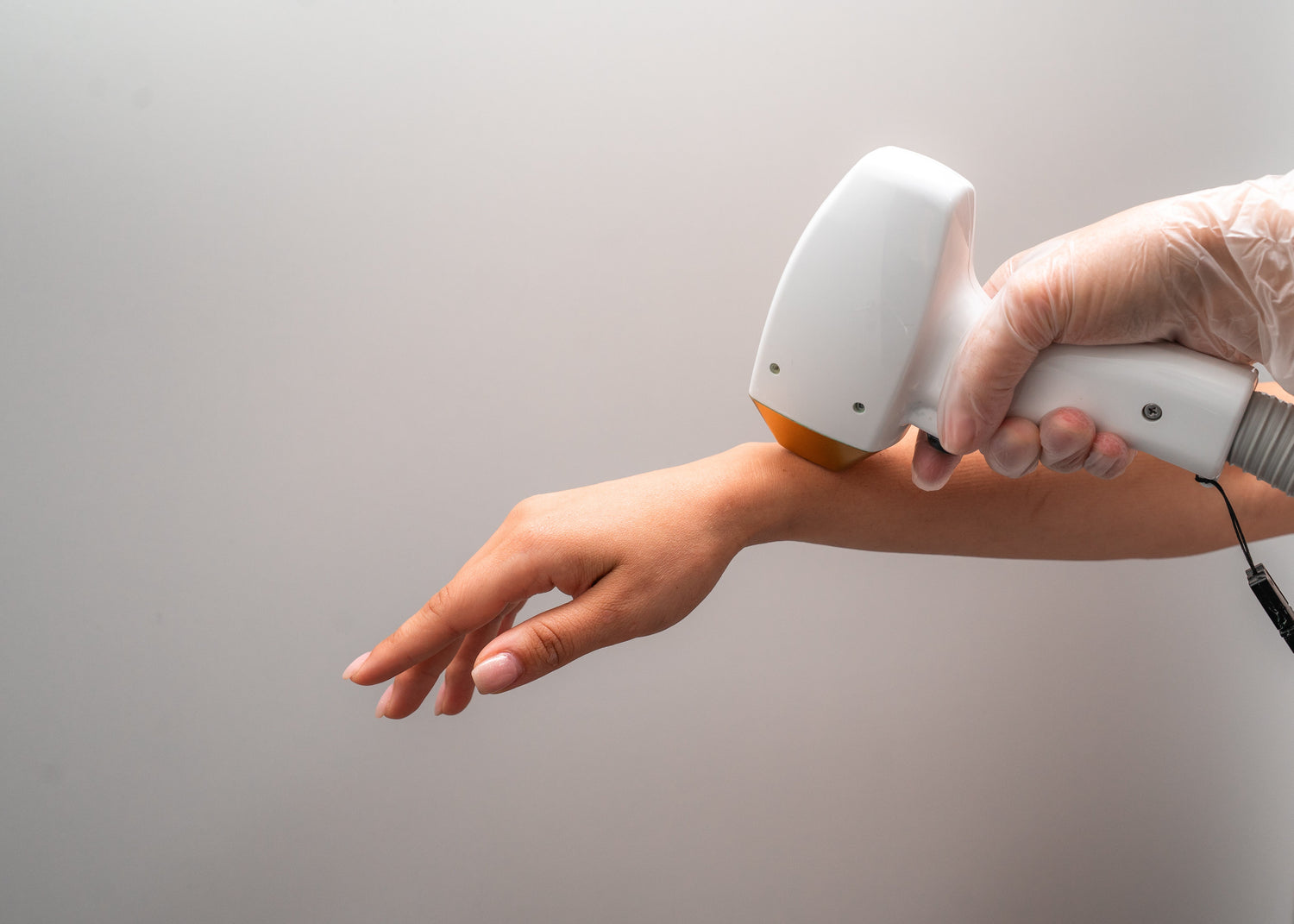 Лазерна епилация